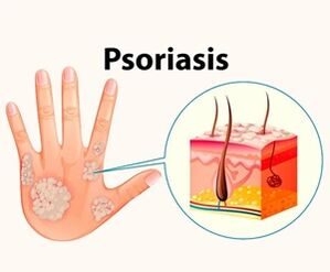 Was ist Psoriasis und warum ist sie gefährlich 